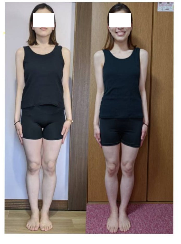 Sさん（30代）のビフォーアフター写真